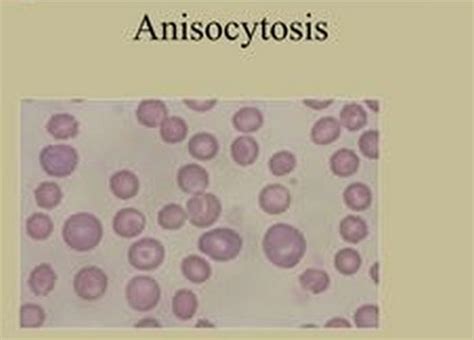 what does anisocytosis present mean.